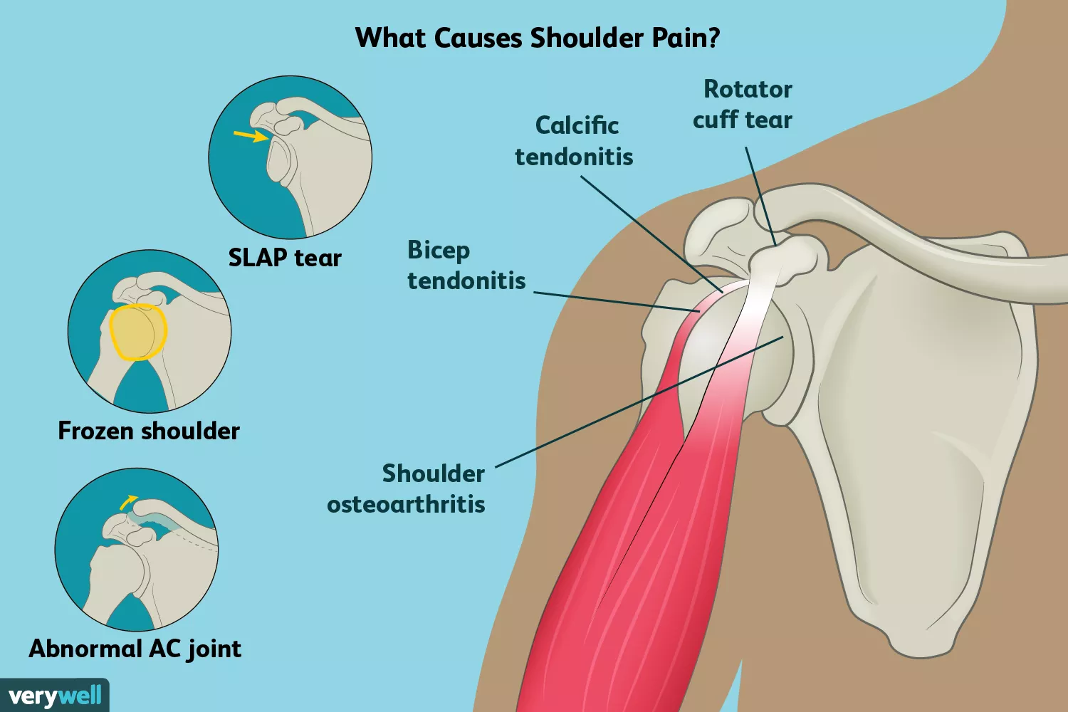 shoulder pain causes